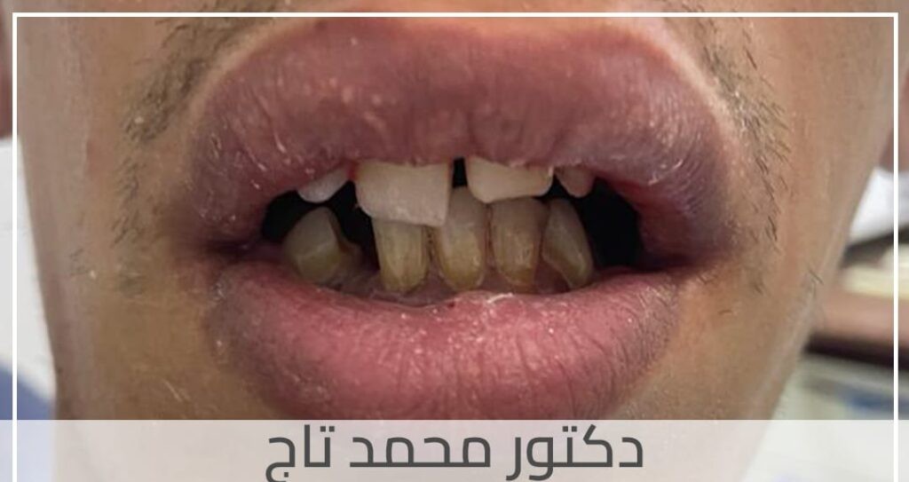 Before treatment image